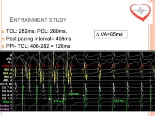 ENTRAINMENT STUDY
 TCL: 282ms, PCL: 280ms,
                                ∆ VA>85ms
 Post pacing interval= 408ms

 PPI- TCL: 408-282 = 126ms
 