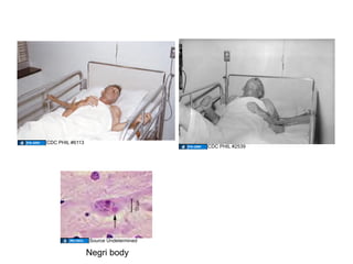 CDC PHIL #6113
                                       CDC PHIL #2539




                 Source Undetermined

                 Negri body
 