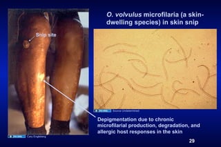 O. volvulus microfilaria (a skin-
                     dwelling species) in skin snip
      Snip site




                        Source Undetermined


                  Depigmentation due to chronic
                  microfilarial production, degradation, and
                  allergic host responses in the skin
Cary Engleberg
                                                       29
 