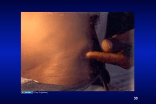 Cary Engleberg


                 30
 