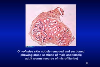 Source Undetermined



O. volvulus skin nodule removed and sectioned,
  showing cross-sections of male and female
     adult worms (source of microfiliariae)
                                                 31
 