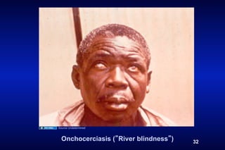 Source Undetermined



  Onchocerciasis ( River blindness )   32
 