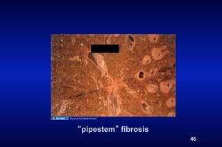 Source Undetermined



        pipestem fibrosis
                            46
 