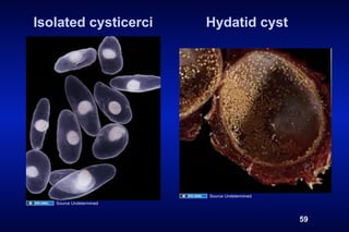 Isolated cysticerci      Hydatid cyst




                         Source Undetermined
   Source Undetermined


                                               59
 