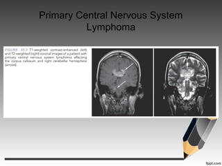 Primary Central Nervous System
Lymphoma
 
