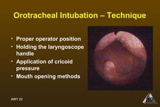 AWY 22
®
Orotracheal Intubation – Technique
• Proper operator position
• Holding the laryngoscope
handle
• Application of cricoid
pressure
• Mouth opening methods
 