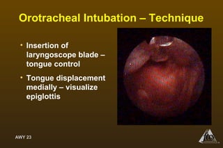 AWY 23
®
Orotracheal Intubation – Technique
• Insertion of
laryngoscope blade –
tongue control
• Tongue displacement
medially – visualize
epiglottis
 