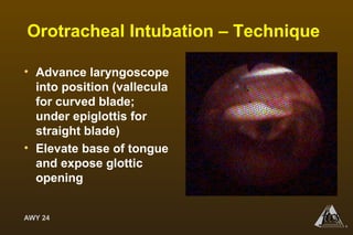 AWY 24
®
Orotracheal Intubation – Technique
• Advance laryngoscope
into position (vallecula
for curved blade;
under epiglottis for
straight blade)
• Elevate base of tongue
and expose glottic
opening
 