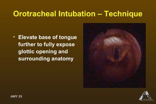 AWY 25
®
Orotracheal Intubation – Technique
• Elevate base of tongue
further to fully expose
glottic opening and
surrounding anatomy
 