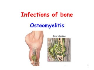 1
Infections of bone
Osteomyelitis
 