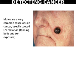 Moles are a very
common cause of skin
cancer, usually caused
UV radiation (tanning
beds and sun
exposure)
DETECTING CANCER
 