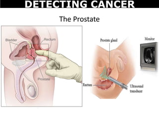 The Prostate
DETECTING CANCER
 
