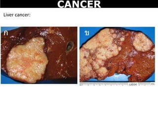 Liver cancer:
CANCER
 