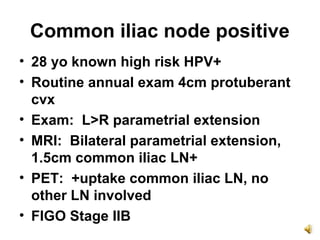 Common iliac node positive
• 28 yo known high risk HPV+
• Routine annual exam 4cm protuberant
  cvx
• Exam: L>R parametria...