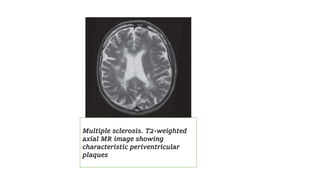 Multiple sclerosis. T2-weighted
axial MR image showing
characteristic periventricular
plaques
 