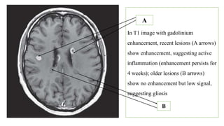 In T1 image with gadolinium
enhancement, recent lesions (A arrows)
show enhancement, suggesting active
inflammation (enhancement persists for
4 weeks); older lesions (B arrows)
show no enhancement but low signal,
suggesting gliosis
A
B
 