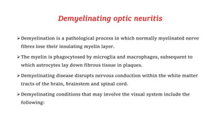 Demyelinating optic neuritis
Demyelination is a pathological process in which normally myelinated nerve
fibres lose their insulating myelin layer.
The myelin is phagocytosed by microglia and macrophages, subsequent to
which astrocytes lay down fibrous tissue in plaques.
Demyelinating disease disrupts nervous conduction within the white matter
tracts of the brain, brainstem and spinal cord.
Demyelinating conditions that may involve the visual system include the
following:
 