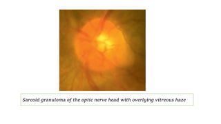Sarcoid granuloma of the optic nerve head with overlying vitreous haze
 