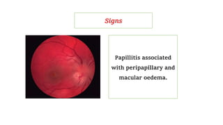 Papillitis associated
with peripapillary and
macular oedema.
Signs
 