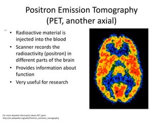 Positron Emission Tomography
                            (PET, another axial)
       • Radioactive material is
 1.7




         injected into the blood
       • Scanner records the
         radioactivity (positron) in
         different parts of the brain
       • Provides information about
         function
       • Very useful for research




For more detailed information about PET, goto:
http://en.wikipedia.org/wiki/Positron_emission_tomography
 
