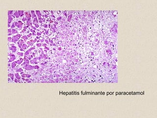 Hepatitis fulminante por paracetamol
 
