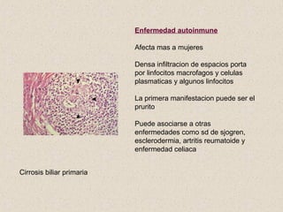 Enfermedad autoinmune

                           Afecta mas a mujeres

                           Densa infiltracion de espacios porta
                           por linfocitos macrofagos y celulas
                           plasmaticas y algunos linfocitos

                           La primera manifestacion puede ser el
                           prurito

                           Puede asociarse a otras
                           enfermedades como sd de sjogren,
                           esclerodermia, artritis reumatoide y
                           enfermedad celiaca


Cirrosis biliar primaria
 