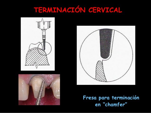 Lineas De Terminacion En Protesis Fija Articulos es.slideshare.net