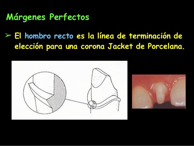 Lineas De Terminacion En Protesis Fija Articulos www.slideshare.net