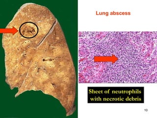 Spr 09 10
Sheet of neutrophils
with necrotic debris
Lung abscess
 
