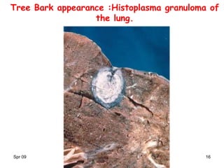 Spr 09 16
Tree Bark appearance :Histoplasma granuloma of
the lung.
 