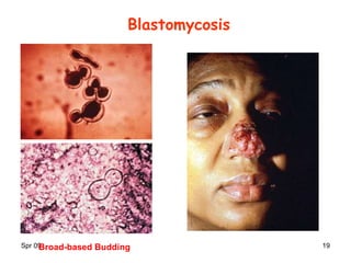 Spr 09 19
Blastomycosis
Broad-based Budding
 