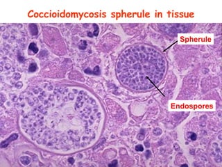 Spr 09 21
Coccioidomycosis spherule in tissue
Spherule
Endospores
 