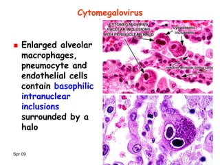 Spr 09 26
Cytomegalovirus
Enlarged alveolar
macrophages,
pneumocyte and
endothelial cells
contain basophilic
intranuclear
inclusions
surrounded by a
halo
 