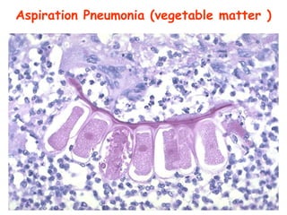Spr 09 4
Aspiration Pneumonia (vegetable matter )
 