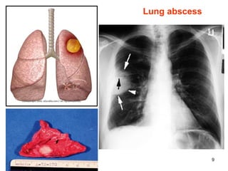 Spr 09 9
Lung abscess
 