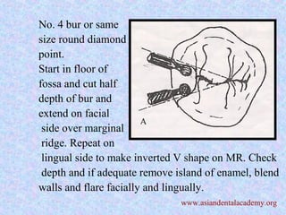 No. 4 bur or same
size round diamond
point.
Start in floor of
fossa and cut half
depth of bur and
extend on facial
side over marginal
ridge. Repeat on
lingual side to make inverted V shape on MR. Check
depth and if adequate remove island of enamel, blend
walls and flare facially and lingually.
www.asiandentalacademy.org
 