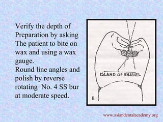 Verify the depth of
Preparation by asking
The patient to bite on
wax and using a wax
gauge.
Round line angles and
polish by reverse
rotating No. 4 SS bur
at moderate speed.
www.asiandentalacademy.org
 