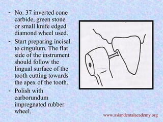 - No. 37 inverted cone
carbide, green stone
or small knife edged
diamond wheel used.
- Start preparing incisal
to cingulum. The flat
side of the instrument
should follow the
lingual surface of the
tooth cutting towards
the apex of the tooth.
- Polish with
carborundum
impregnated rubber
wheel.
www.asiandentalacademy.org
 