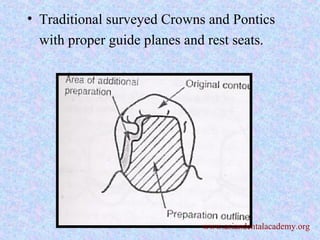 • Traditional surveyed Crowns and Pontics
with proper guide planes and rest seats.
www.asiandentalacademy.org
 
