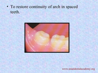 • To restore continuity of arch in spaced
teeth.
www.asiandentalacademy.org
 