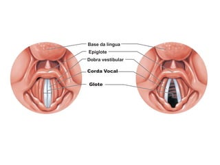 Base da língua
Epiglote
Dobra vestibular
Corda Vocal
Glote
 
