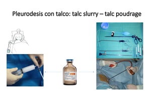 Pleurodesis con talco: talc slurry – talc poudrage
 