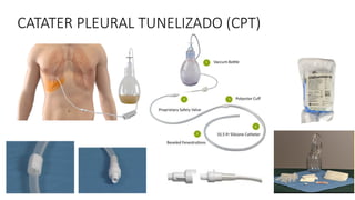CATATER PLEURAL TUNELIZADO (CPT)
 