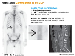 METS - Ca. de céls renales
FOCOS FRÍOS: (FOTOPÉNICAS):
• Usualmente agresivas
• MUY osteolíticas = depleción de osteoblastos
DD: Necrosis avascular
Ca. de céls. renales, tiroides, anaplásicos,
mieloma múltiple. Rara vez: Pulmón, mama,
neuroblastoma
Metástasis: Gammagrafía Tc-99 MDP
DD: Diagnóstico diferencial
 