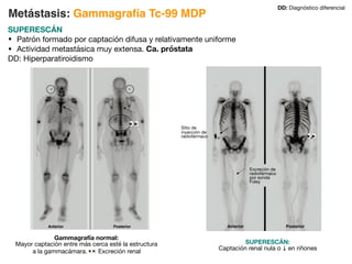 SUPERESCÁN
• Patrón formado por captación difusa y relativamente uniforme
• Actividad metastásica muy extensa. Ca. próstata
DD: Hiperparatiroidismo
Metástasis: Gammagrafía Tc-99 MDP
DD: Diagnóstico diferencial
Gammagrafía normal:
Mayor captación entre más cerca esté la estructura
a la gammacámara. # Excreción renal
#
#
SUPERESCÁN:
Captación renal nula o ↓ en riñones
Sitio de
inyección de
radiofármaco
Excreción de
radiofármaco
por sonda
Foley
 