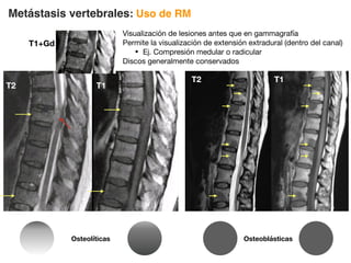 Metástasis vertebrales: Uso de RM
Visualización de lesiones antes que en gammagrafía
Permite la visualización de extensión extradural (dentro del canal)
• Ej. Compresión medular o radicular
Discos generalmente conservados
T2
T2
T1
T1
Osteoblásticas
Osteolíticas
T1+Gd
 