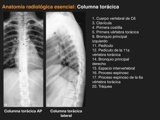 iDESIGN
by HiSlide.io
Anatomía radiológica esencial: Columna torácica
1. Cuerpo vertebral de C6
3. Clavícula
4. Primera costilla
5. Primera vértebra torácica
9. Bronquio principal
izquierdo
11. Pedículo
12. Pedículo de la 11a
vértebra torácica
14. Bronquio principal
derecho
15. Espacio intervertebral
16. Proceso espinoso
17. Proceso espinoso de la 6a
vértebra torácica
20. Tráquea
Columna torácica AP Columna torácica
lateral
 