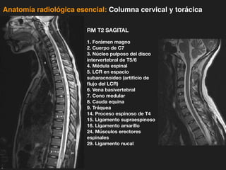 iDESIGN
by HiSlide.io
Anatomía radiológica esencial: Columna cervical y torácica
RM T2 SAGITAL
1. Forámen magno
2. Cuerpo de C7
3. Núcleo pulposo del disco
intervertebral de T5/6
4. Médula espinal
5. LCR en espacio
subaracnoideo (artificio de
flujo del LCR)
6. Vena basivertebral
7. Cono medular
8. Cauda equina
9. Tráquea
14. Proceso espinoso de T4
15. Ligamento supraespinoso
16. Ligamento amarillo
24. Músculos erectores
espinales
29. Ligamento nucal
 