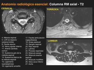 iDESIGN
by HiSlide.io
Anatomía radiológica esencial: Columna RM axial - T2
4. Médula espinal
5. LCR es espacio
subaracnoideo
8. Cauda equina
10. Vena yugular interna
11. Arteria carótida
común
12. Sustancia gris de la
médula espinal
13. Sustancia blanca de
la médula espinal
15. Ligamento
supraespinoso
16. Ligamento amarillo
17. Faceta (articulación
cigapofisiaria)
18. Grasa epidural
19. Ganglio espinal
20. Raíz espinal
21. Lámina
22. Proceso espinoso
23. Músculo psoas
24. Músculo erector
espinal
25. Músculo multífido
26. Vena cava inferior
27. Aorta
CERVICAL TORÁCICA
LUMBAR
 