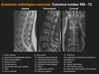 iDESIGN
by HiSlide.io
Anatomía radiológica esencial: Columna lumbar RM - T2
1. Anillo fibroso
2. Ligamento longitudinal anterior
3. Vena basivertebral
4. Cuerpo de L3
5. Cauda equina
6. Saco tecal del canal lumbar
7. LCR
8. Cono medular
Sagital Parasagital Coronal
9. Saco dural
10. Espacio graso epidural
11. Hendidura internuclear
12. Ligamento interespinoso
13. Forámen intervertebral
14. Riñón
15. Ligamento amarillo
16. Núcleo pulposo
17. Pedículo
18. Ligamento longitudinal posterior y
anillo fibroso
19. Psoas
20. Vasos radiculares
21. Promontorio sacro
22. Raíz del nervio espinal en forámen
intervertebral
 